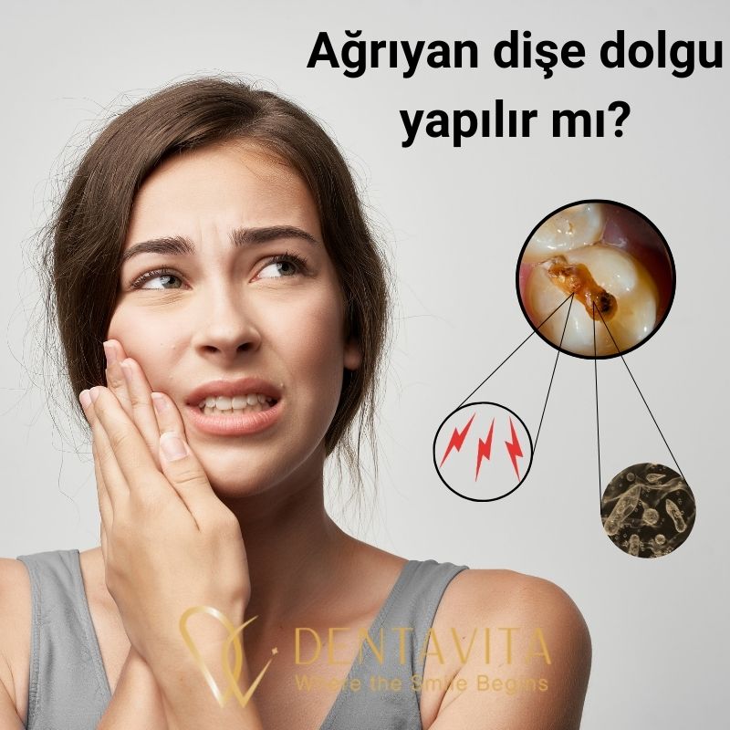 Ağrıyan Dişe Dolgu Yapılır mı? Ağrılı Çürük Dişe Dolgu Yapılır mı? İstanbul