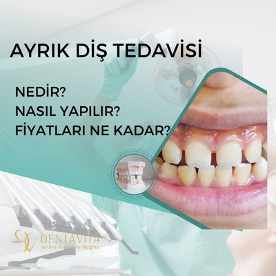 Ayrık Diş (Diastemalı Diş) Tedavisi; Nedir? Nasıl Yapılır? Fiyatları Ne Kadar?