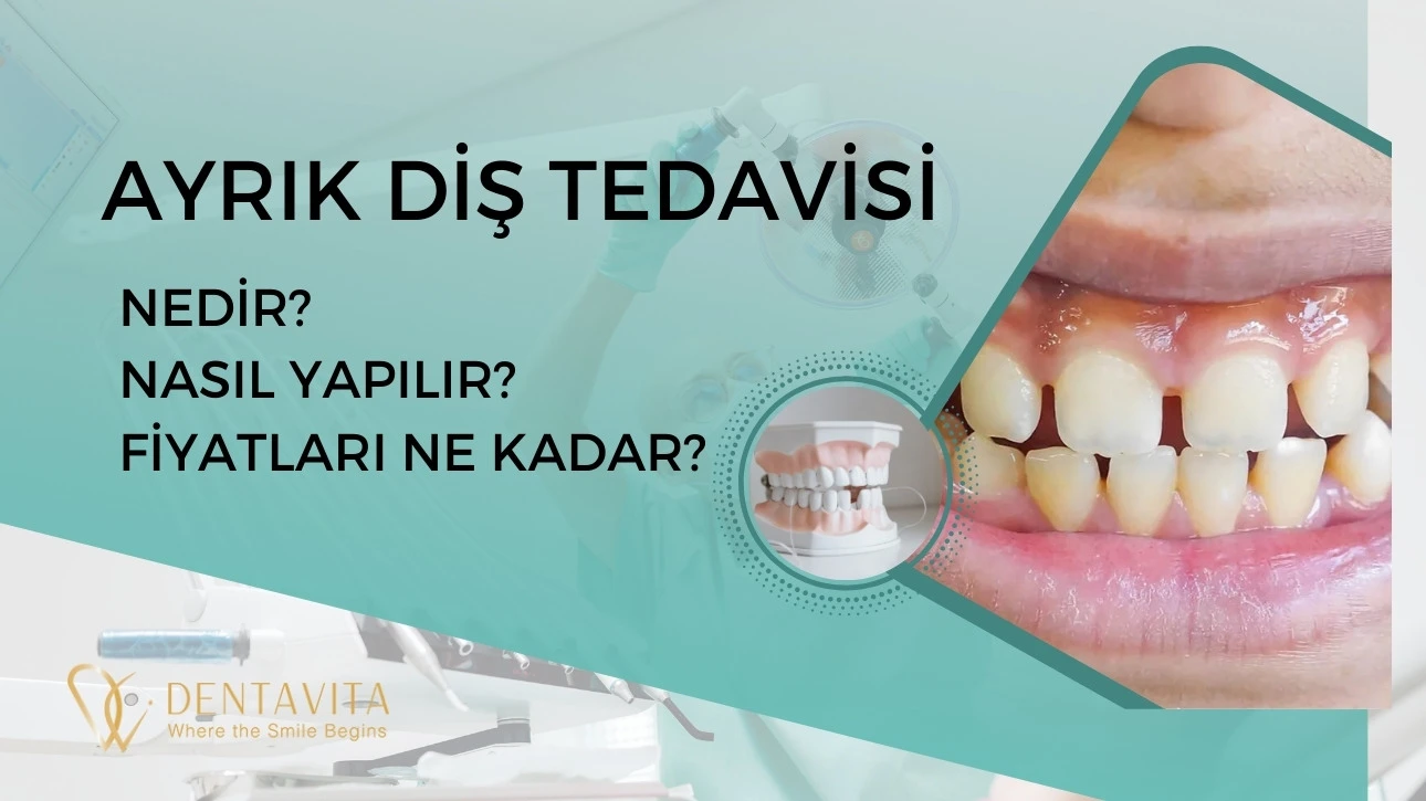 Ayrık Diş (Diastemalı Diş) Tedavisi Nedir? Nasıl Yapılır? Fiyatları İstanbul