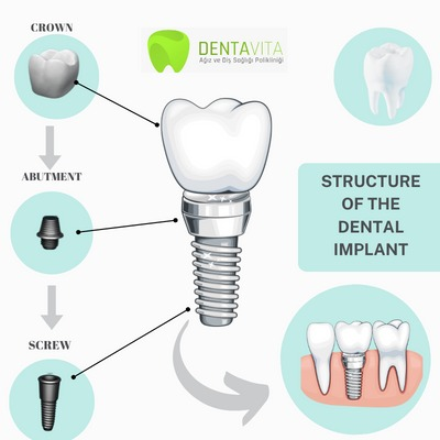 Dental Implant Istanbul | Full Mouth Dental Implants Turkey Package Deals