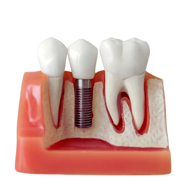 implant diş kliniği istanbul