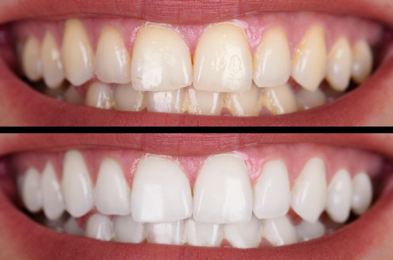 How to Get Rid of Yellow Stains on Teeth?