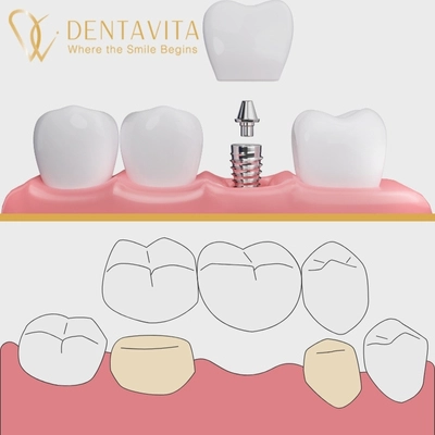 Dental Bridge or Implant