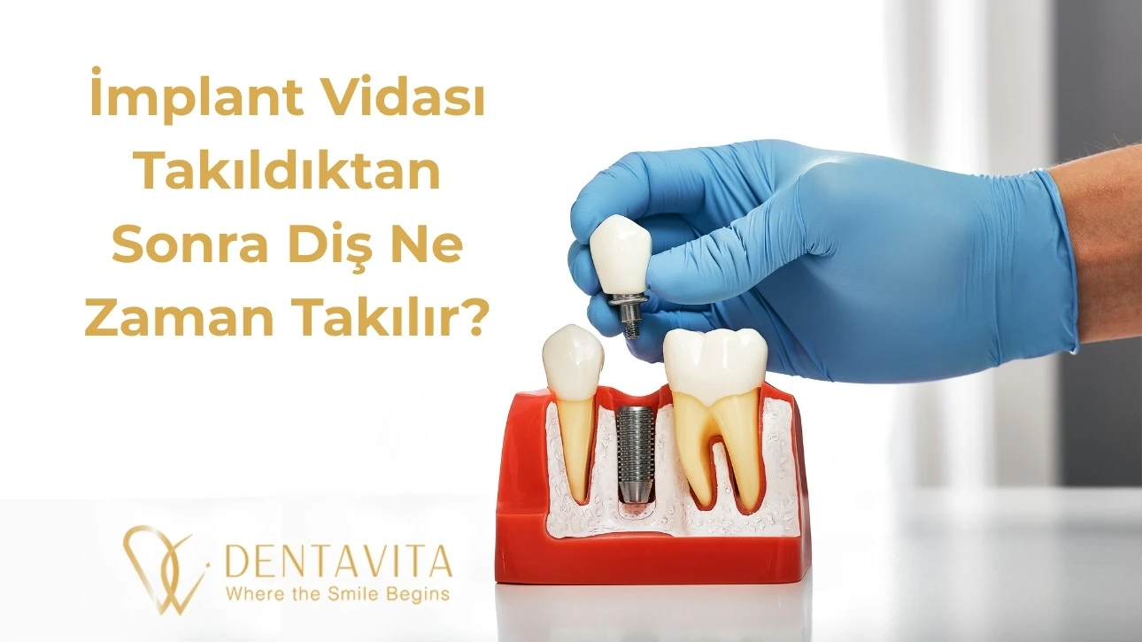 İmplant Vidası Takıldıktan Sonra Diş Ne Zaman Takılır? Adım Adım İyileşme Süreci İmplant Vidası Takıldıktan Sonra Diş Ne Zaman Takılır? Adım Adım İyileşme Süreci İstanbul