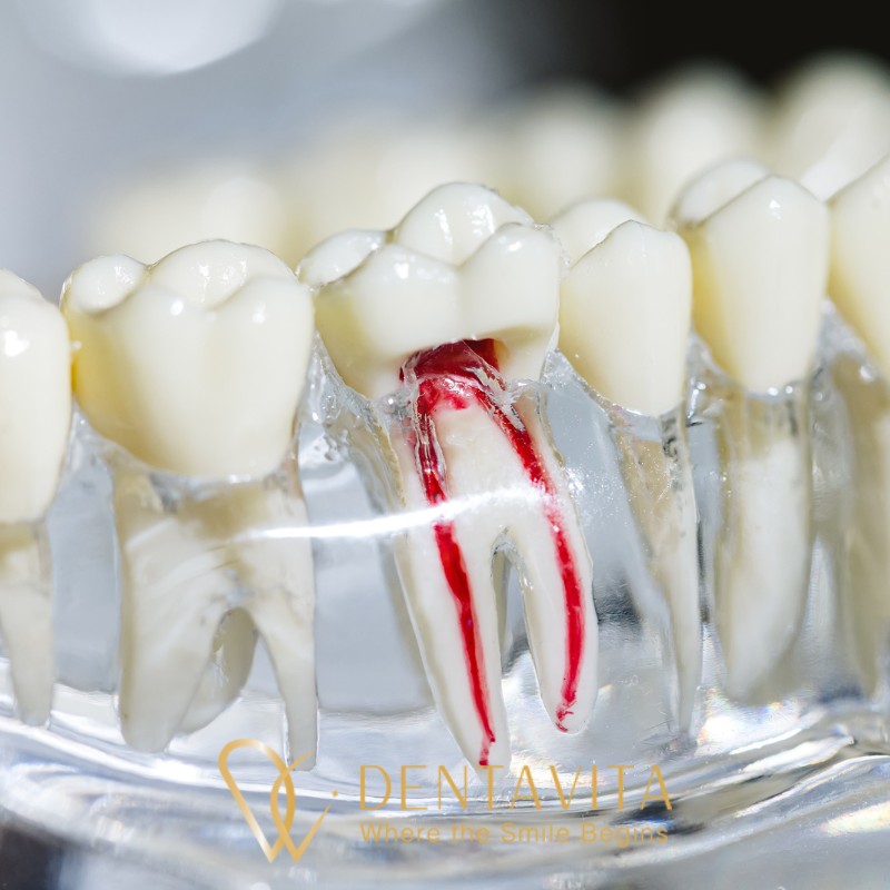 Kanal Tedavisi Sonrası Diş Üstüne Basamama ve Ağrı Neden Olur?