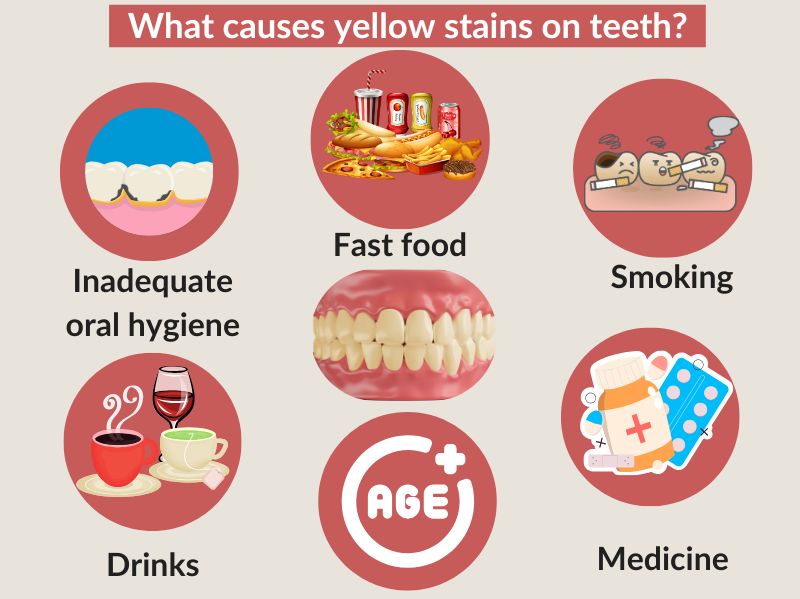 What Causes Yellow Stains on Teeth?