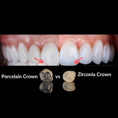 Zirconia vs Porcelain Crowns