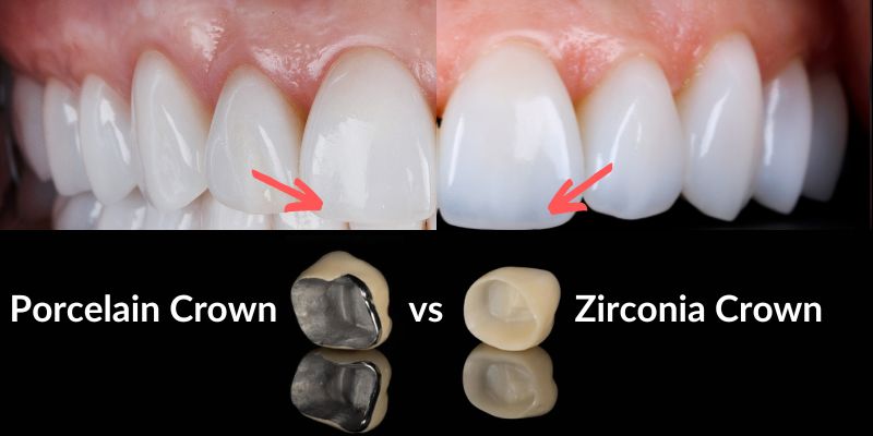 zirconium crowns vs porcelain